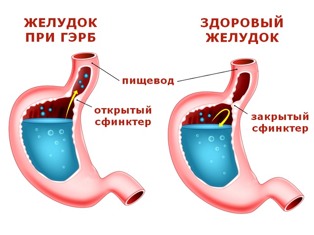 Что такое гастроэзофагеальная рефлюксная болезнь и чем она опасна?